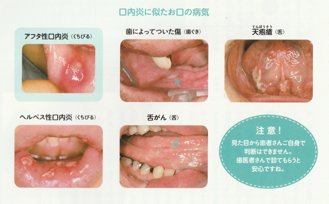 口内炎について