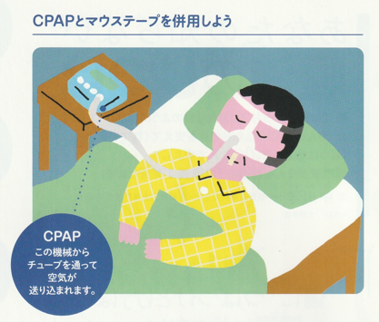 マウステーピングとCPAPの相互作用について