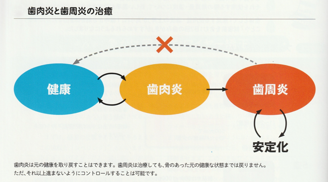 歯肉炎と歯周炎の違い