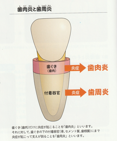 歯肉炎と歯周炎の違い