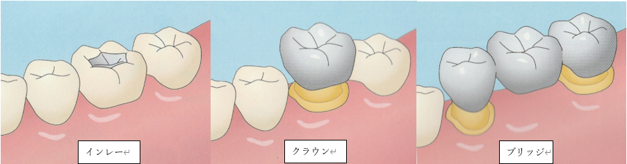 詰め物・被せものについて
