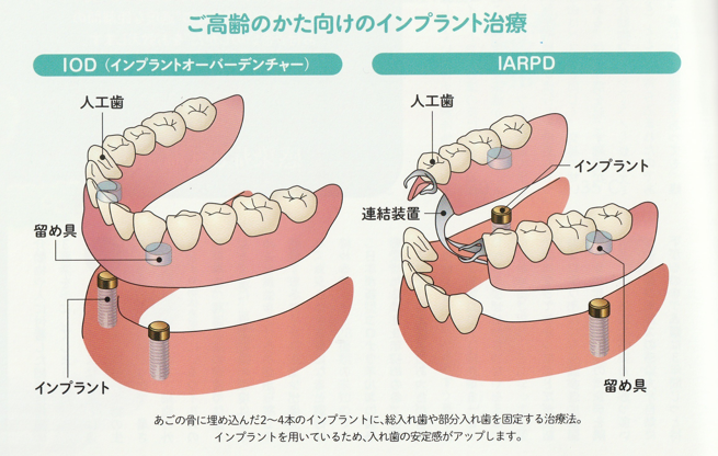 入れ歯をがっちりさせるいい方法はないの？