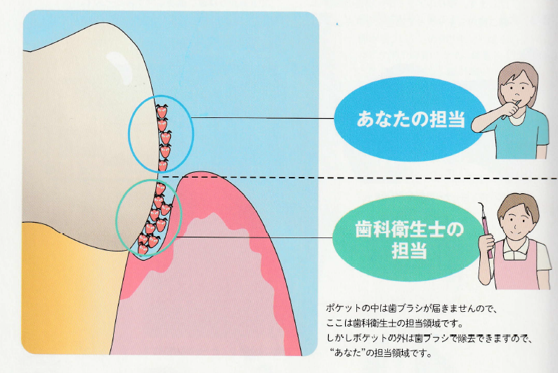 歯周病の原因菌てそもそも何？