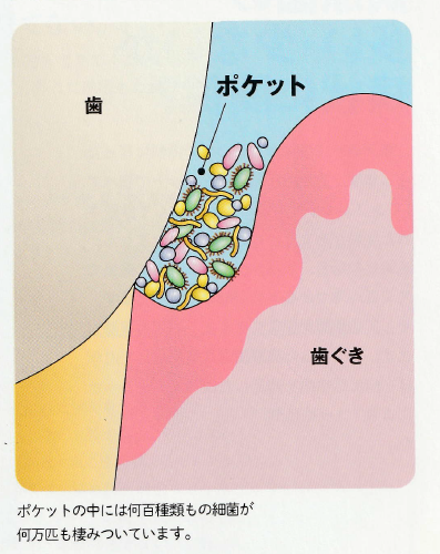 歯周病の原因菌てそもそも何？