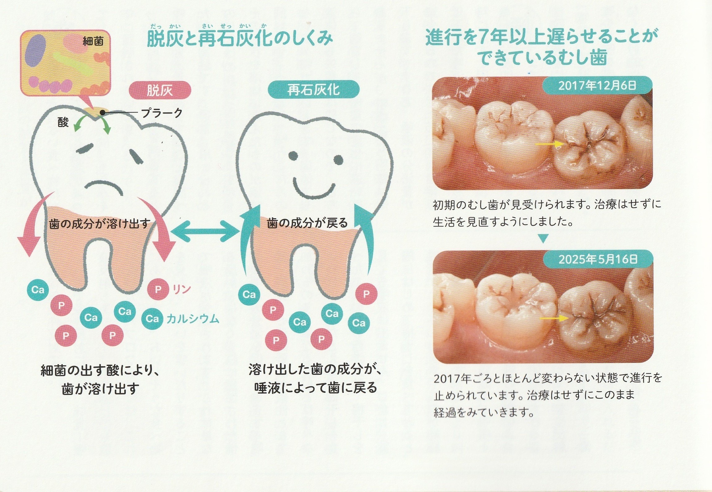 黒い溝=むし歯?必ずしもそうとは限りません
