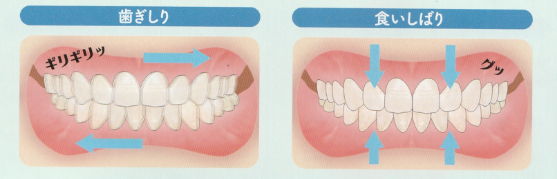 ナイトガードで歯を守りましょう