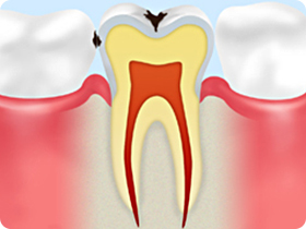エナメル質の虫歯【C1】