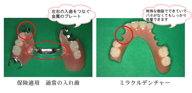 こうすけ歯科医院の特殊義歯