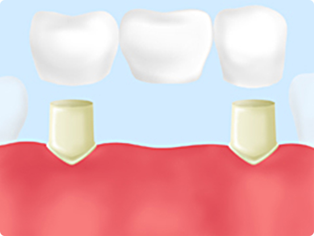 ブリッジ治療の特徴